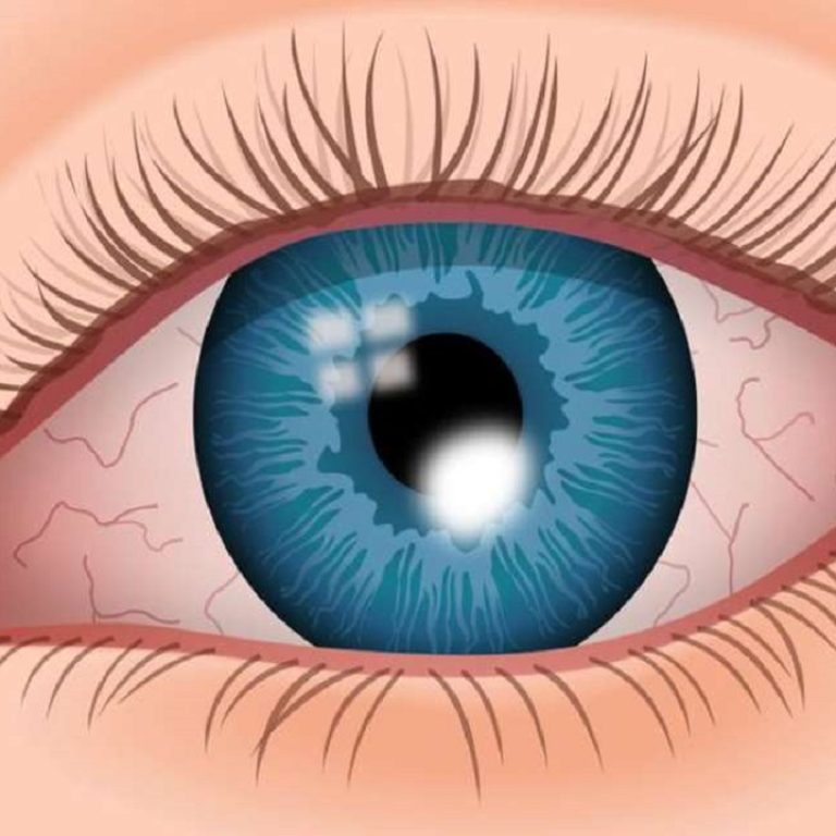 Benh-viem-loet-giac-mac-la-gi-Cach-phong-benh-hieu-qua