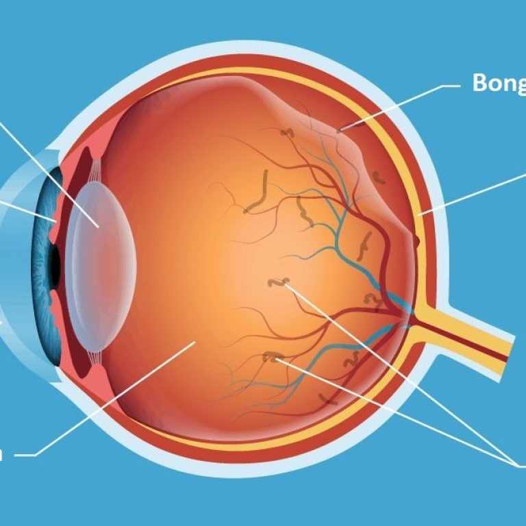 Bong-vong-mac-Nguyen-nhan-va-phuong-phap-dieu-tri