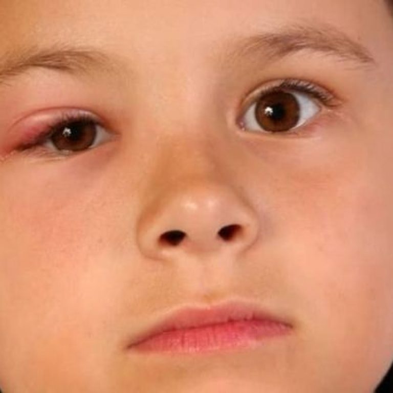 Cach-chua-leo-mat-tre-em-an-toan-hieu-qua