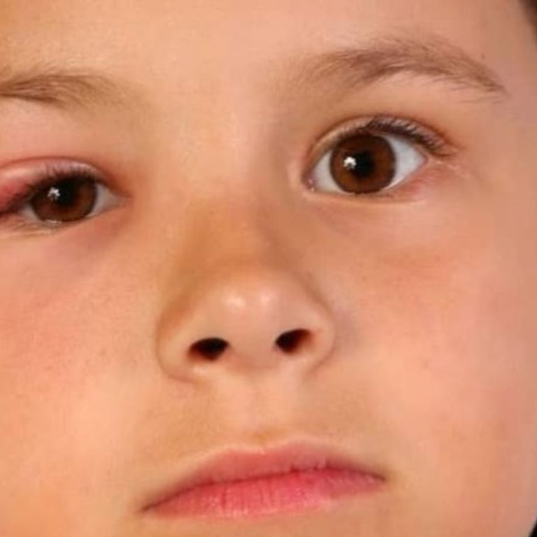 Cach-chua-tri-leo-mat-o-tre-em-hieu-qua