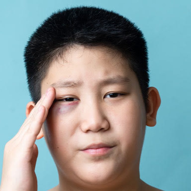 Cach-dieu-tri-mat-bi-tham-tim-hoac-bam-tim