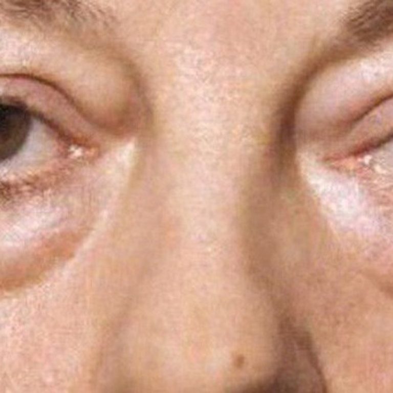 Cach-loai-bong-mat-va-cach-khac-phuc