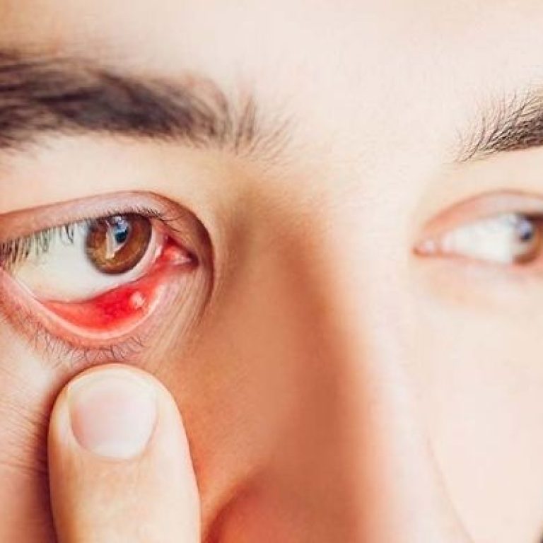 Chua-chap-mat-trong-nhu-the-nao-co-nguy-hiem-khong