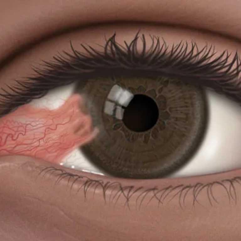 Nguyen-nhan-trieu-chung-va-cach-dieu-tri-benh-mong-mat