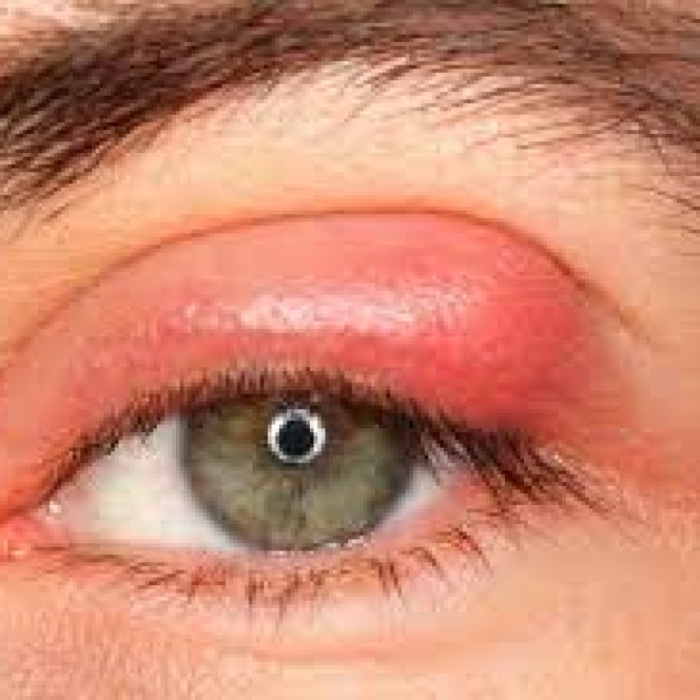 Nguyen-nhan-va-cach-dieu-tri-viem-mi-mat