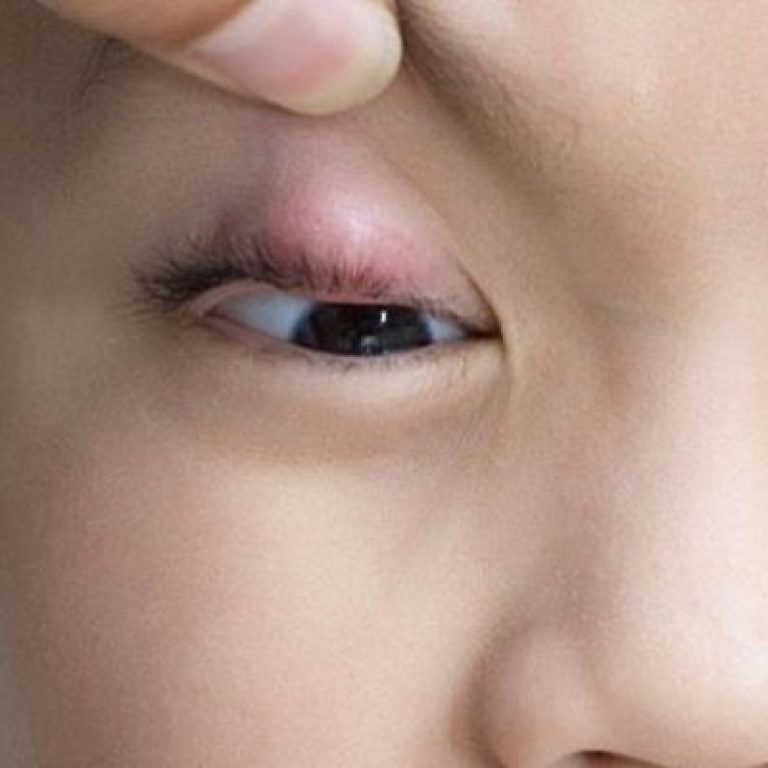 Tai-sao-bi-chap-mat-Nen-rach-chap-mat-khi-nao