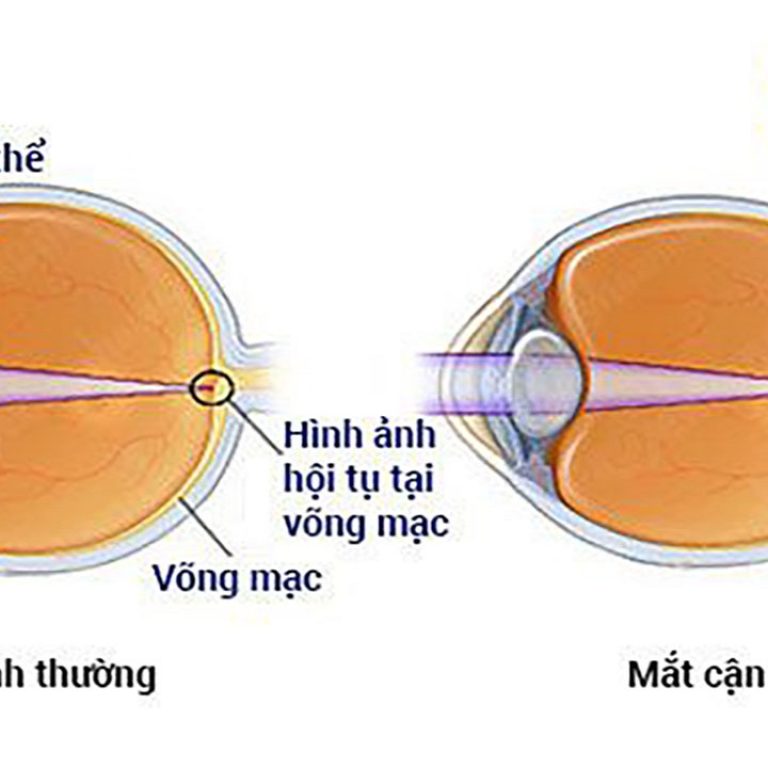 Tat-khuc-xa-o-mat-bieu-hien-nhu-the-nao