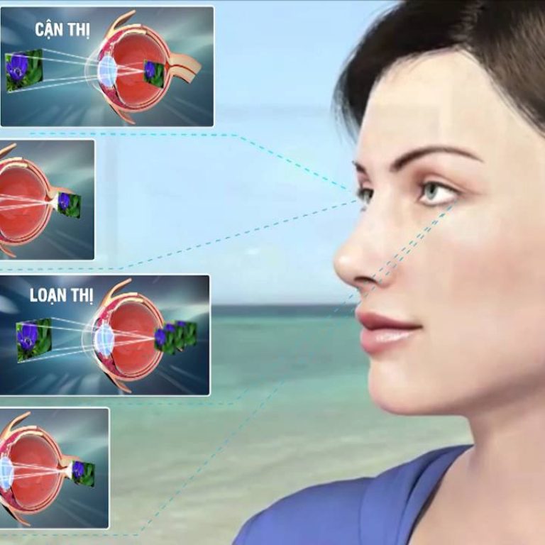 Tat-khuc-xa-ve-mat-co-bien-chung-nguy-hiem-khong