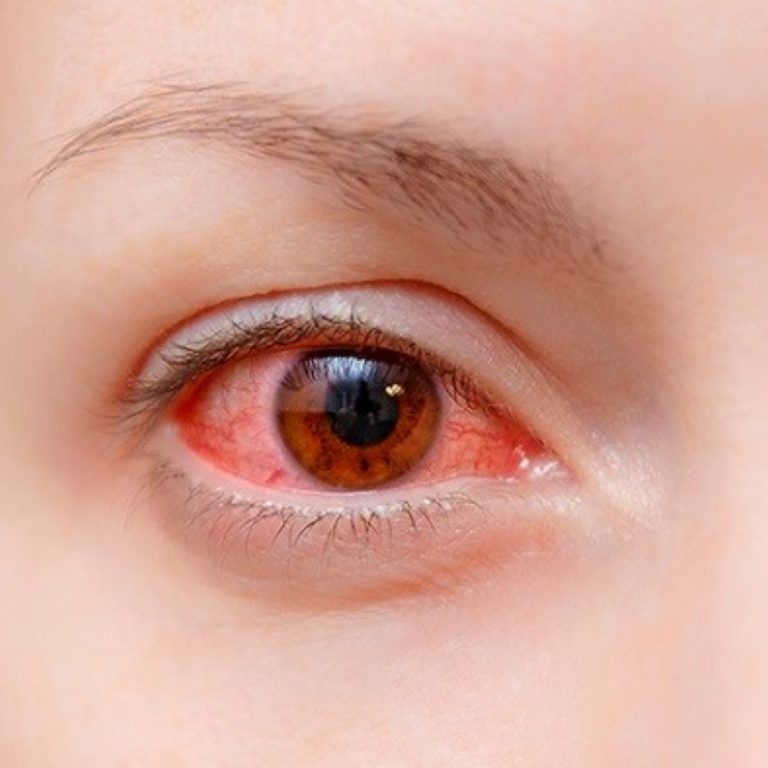 Viem-ket-mac-cap-tinh-Benh-de-lay-nhiem-cho-chu-quan