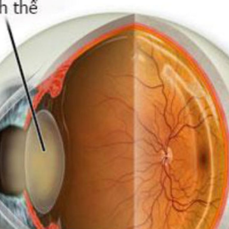 duc-thuy-tinh-the-dieu-tri-va-mo-1280x720-1