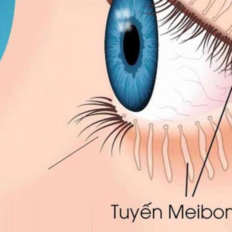 oi-loan-chuc-nang-tuyen-meibomian