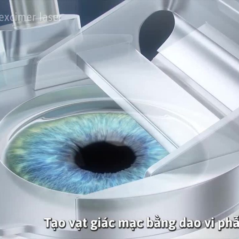phuong-phap-mo-can-thi-lasik-1