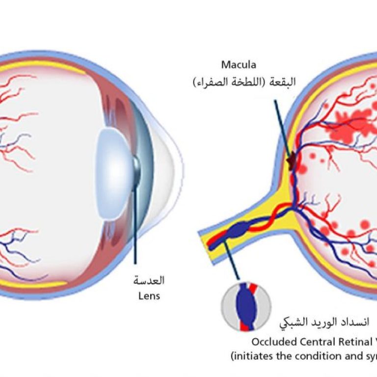 tac-tinh-mach-vong-mac-trung-tam-mat-hikari-1024x517-1