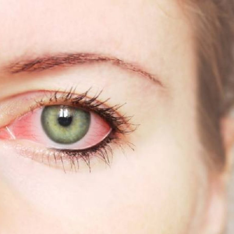 trieu-chung-benh-mat